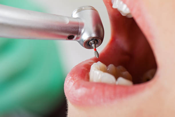 Best Emergency Dentist for Knocked-Out Tooth in Clarksburg, WV